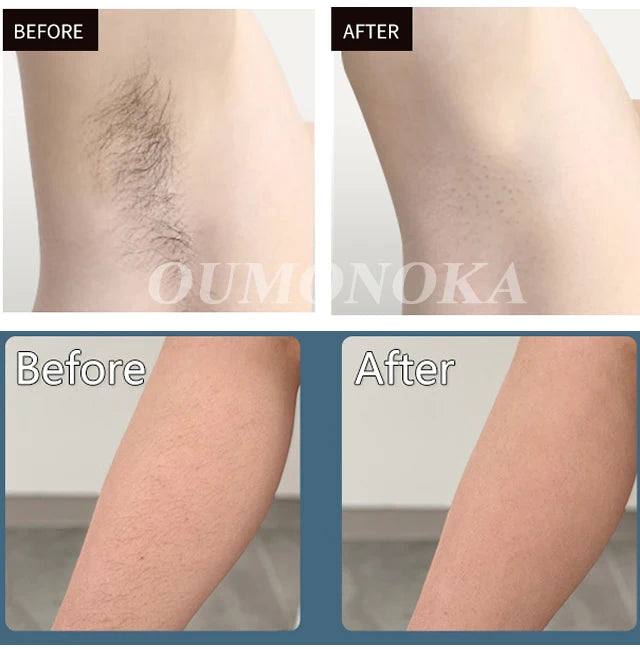 Hair Removal laser