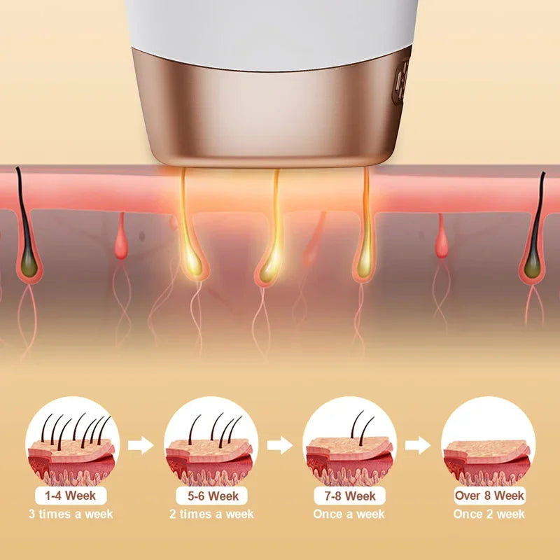 Illustration of IPL hair removal reducing hair growth over time, showing different stages of treatment from 1-4 weeks to over 8 weeks.