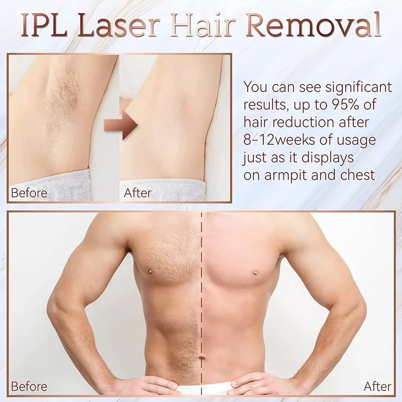 Before and after results of IPL laser hair removal on a man's chest and armpits, showing significant hair reduction."