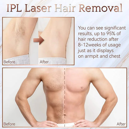 Before and after results of IPL laser hair removal on a man's chest and armpits, showing significant hair reduction."