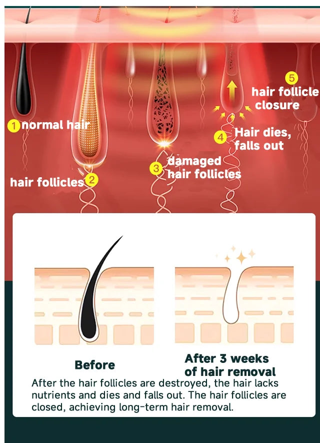 Effective diagram illustrating the process of Hair Removal Home Use Devices for long-term results and hair follicle closure.